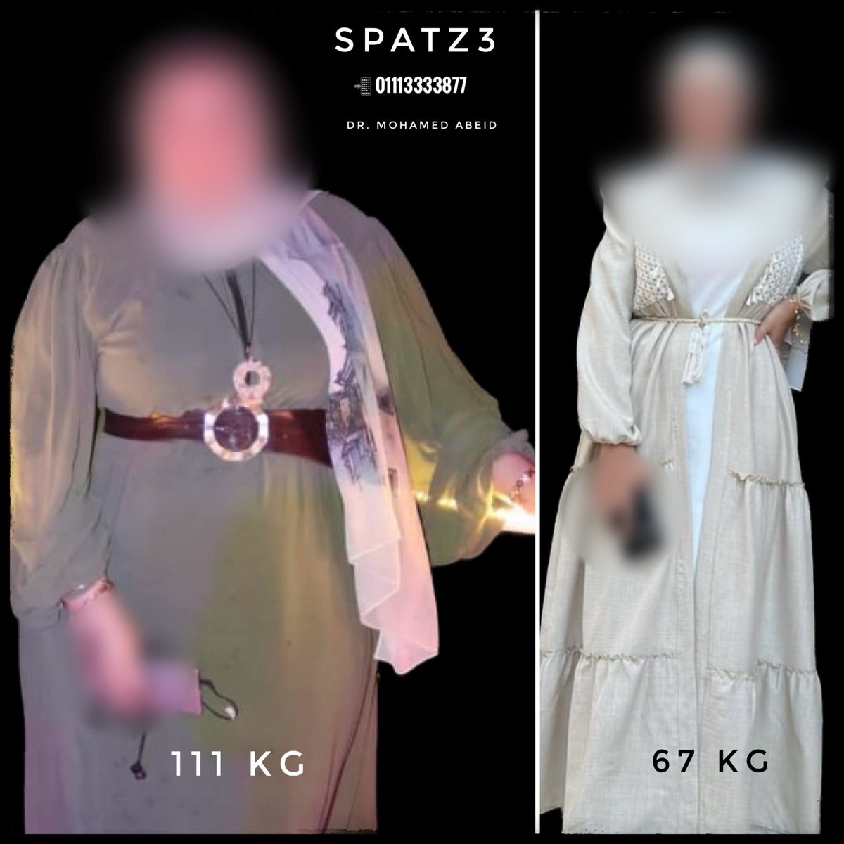 MohamedAbeid's tweet image. #SPATZ3 the best #Weightloss solution!!
44 KG in 1 year
98% EWL
40% TWL
BMI was 42 - now 25!!