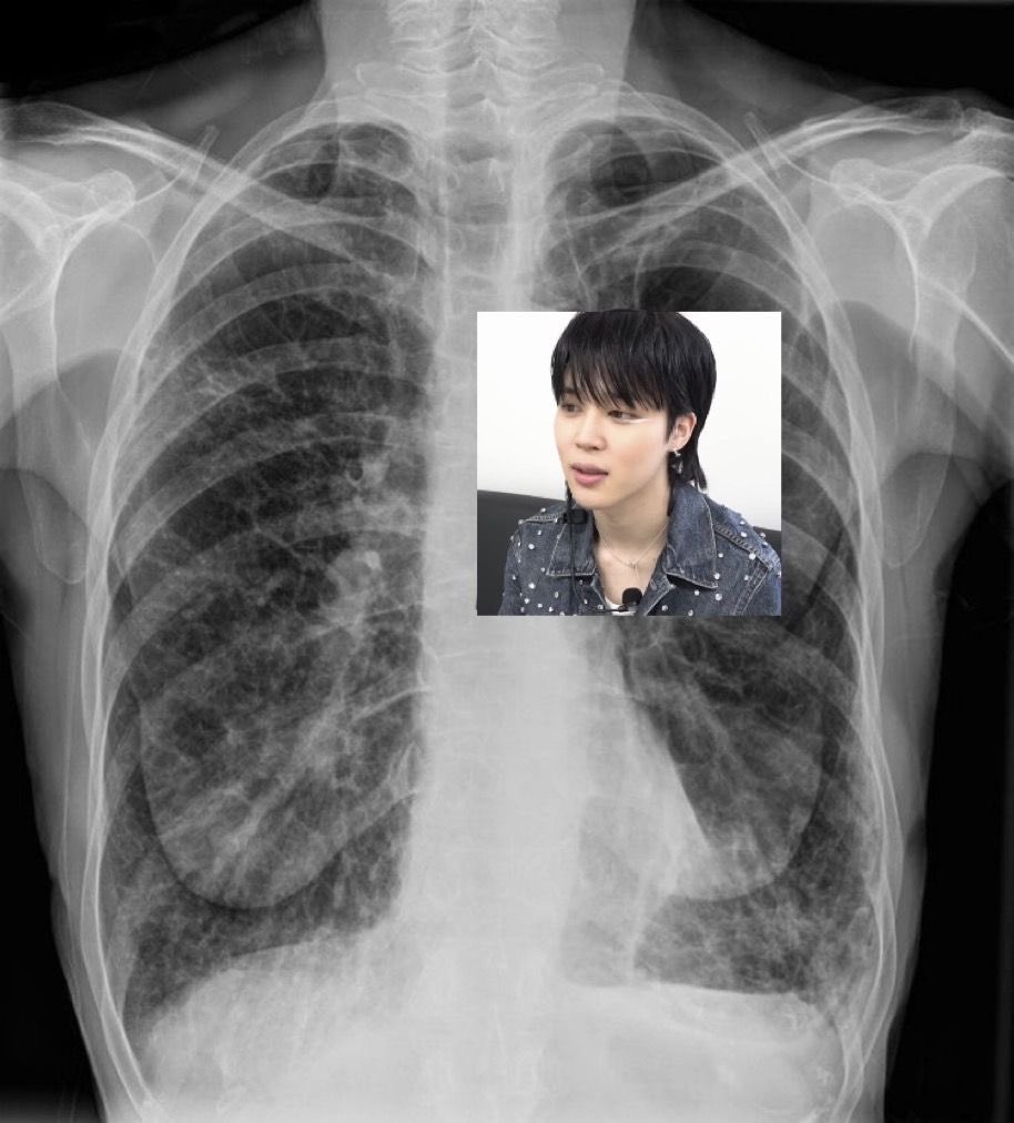 my chest xray just came out omg