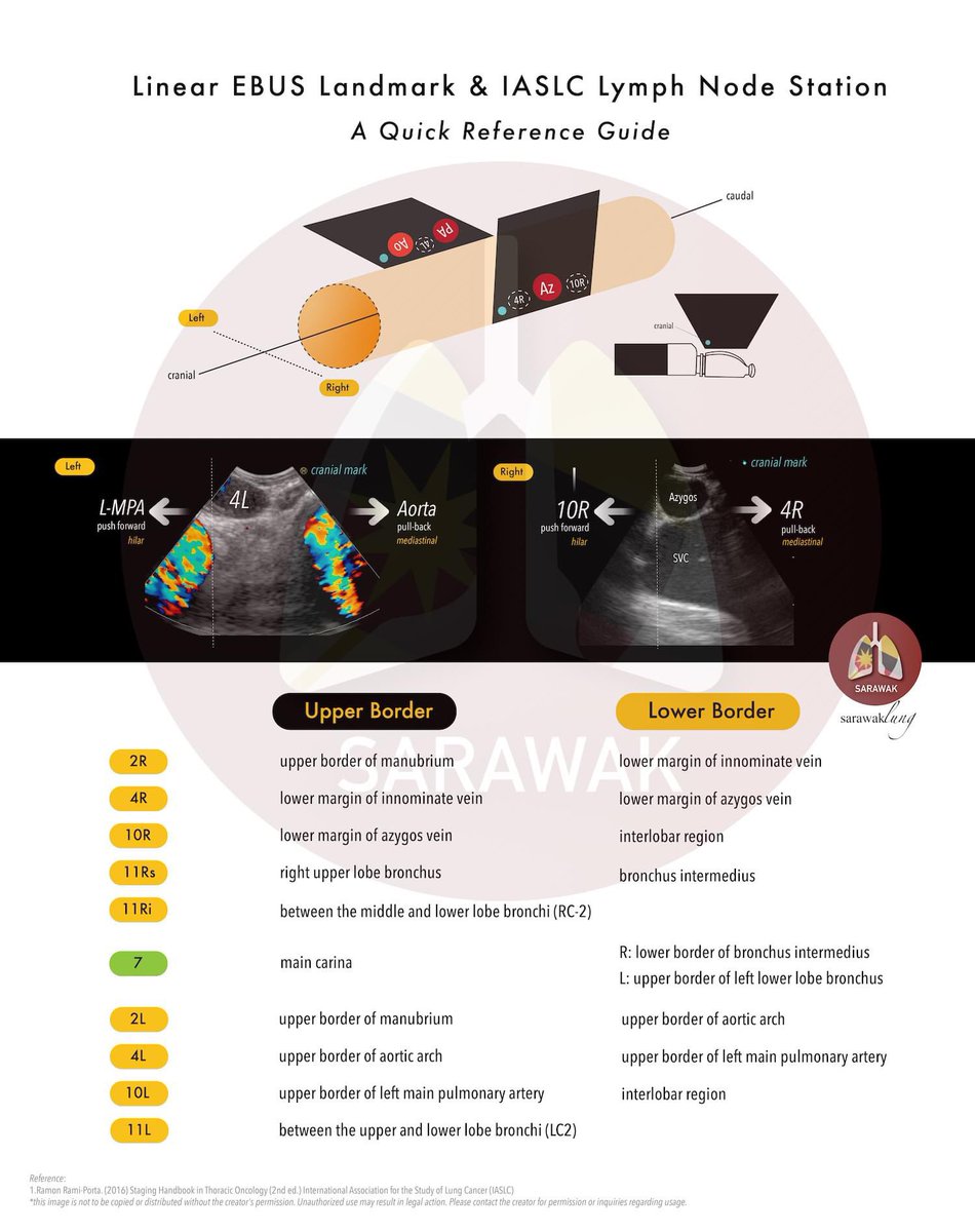 PulmonaryEndos1's tweet photo. the IASLC lymph node map from the EBUS perspective.
this is the course material from our EBUS and cryo workshop last year, i think its time to share with everyone. Apologies for the watermark; we have to keep it. I hope this will be helpful to all.
#EBUS #LymphNodeMap https://t.co/k9VDVTfPBD