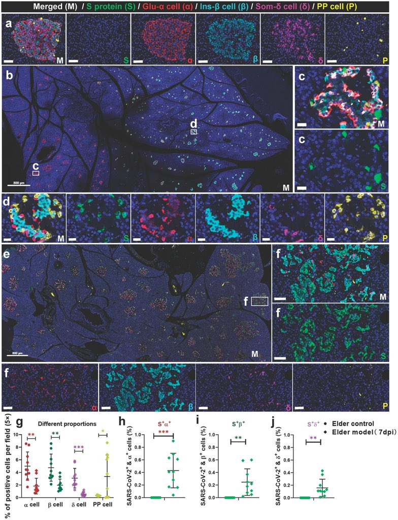 A new study on non-human primates (NHPs) finds that SARS-CoV-2 infection can lead to various levels of pancreatic impairment and dysfunctions of glucose metabolism, especially in elder NHP models. SARS-CoV-2 directly infects the pancreatic islets of NHPs 1/