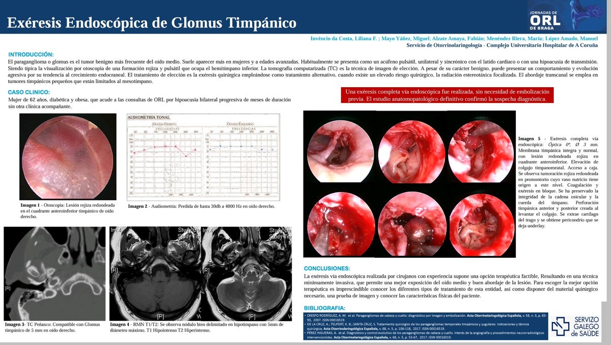 Mayo_ORL's tweet photo. @aeeorlcc @barnaclinic Qué importante es el #marketing... Está claro que no pasaremos a la historia...  

Allá por el 2017 en @ORLCHUAC ya hacíamos este tipo de abordajes y los presentábamos en reuniones internacionales. https://t.co/sJE0XXPVer

Que mal nos vendemos, que poco nos valoramos #chuac 😂 https://t.co/YVfbUYDnrW