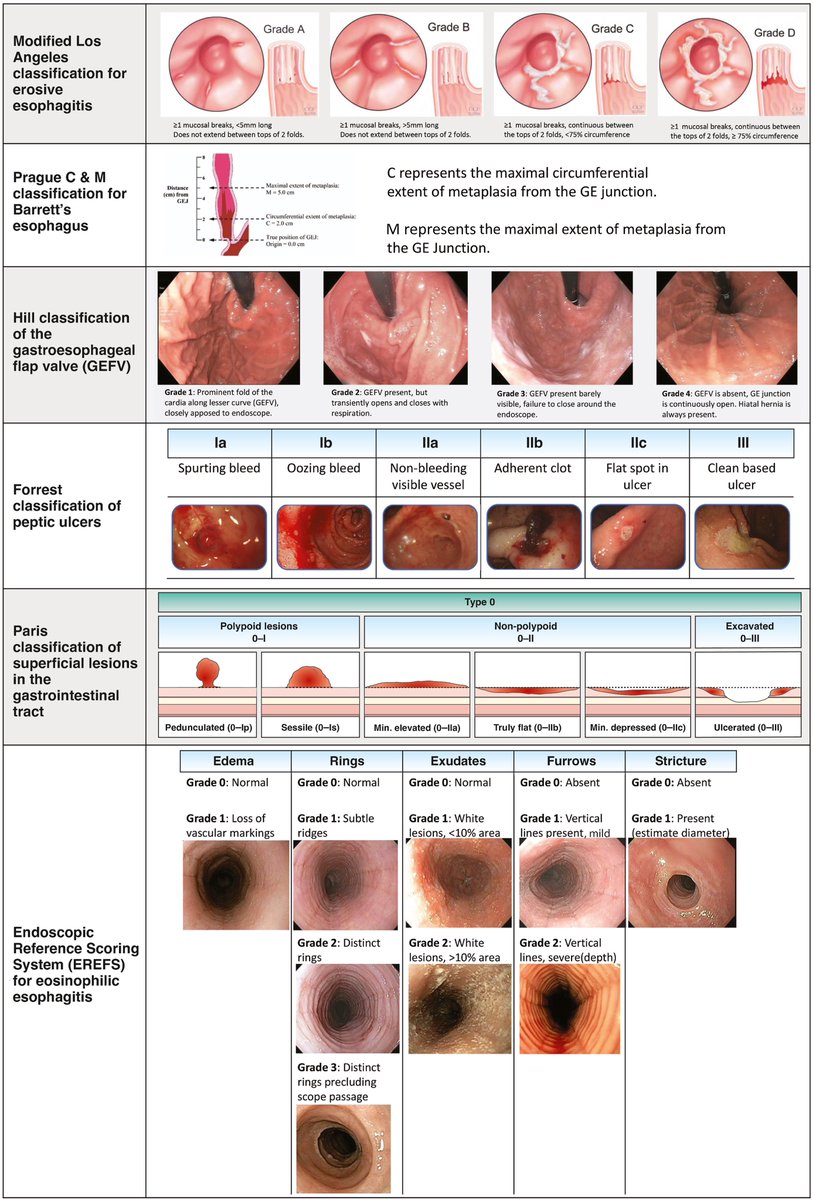 Commonly used classification systems for upper GI endoscopy 💡 cghjournal.org/article/S1542-…