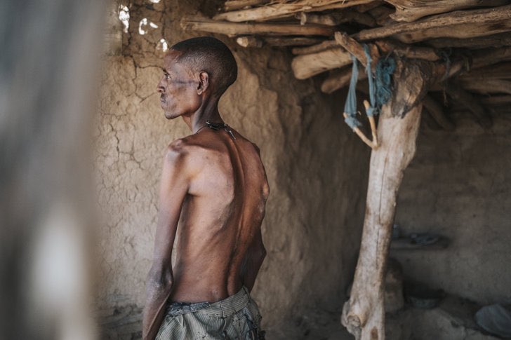#Tigray: Melesa Destu, a tall man in his forties, shows visible ribs, deep-set eyes, and a wandering gaze when he speaks. Like many, he is faced with an impossible choice: dividing the little food they have among his family, risking their starvation, or sacrificing himself to