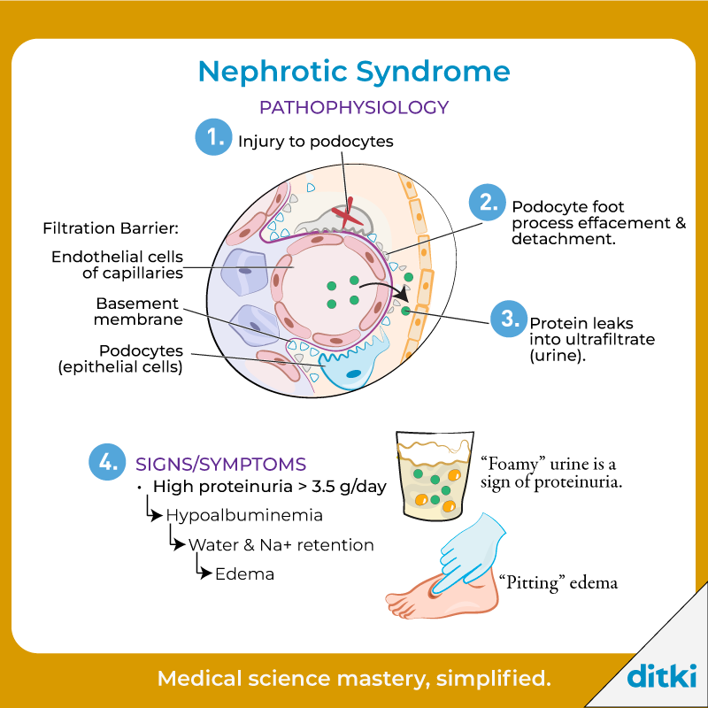 How do we diagnose Nephrotic Syndrome?

l8r.it/kZmh

#ditki #usmle #meded #medschool #medstudent #highered #mededonline #usmletutorials #pathology #nephroticsyndrome #renalpath #kidneypath
#nursing #pance #physicianassistant #medicine #healthscience #nurse #premed