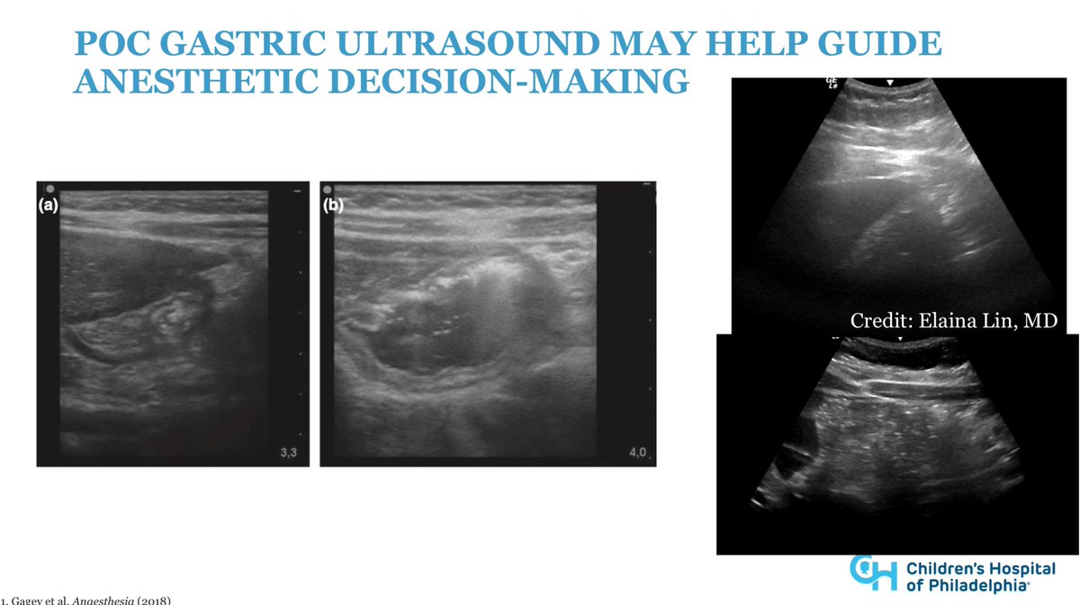 Matthew DiGiusto, MD, FAAP (@pedsgasdoc) on Twitter photo GLP-1 agonists are becoming more prevalent in adolescent patients but come with the risk of delayed gastric emptying. <a href="/ASALifeline/">ASA®</a> recommendations and the use #POCUS in decision making <a href="/JessicaBergerMD/">Jessica A. Berger, MD</a>
<a href="/PediAnesthesia/">SPA</a> <a href="/AmerAcadPeds/">American Academy of Pediatrics</a> #PedsAnes24 #PedsAnes GLP-1 agonists are becoming more prevalent in adolescent patients but come with the risk of delayed gastric emptying. <a href="/ASALifeline/">ASA®</a> recommendations and the use #POCUS in decision making <a href="/JessicaBergerMD/">Jessica A. Berger, MD</a>
<a href="/PediAnesthesia/">SPA</a> <a href="/AmerAcadPeds/">American Academy of Pediatrics</a> #PedsAnes24 #PedsAnes