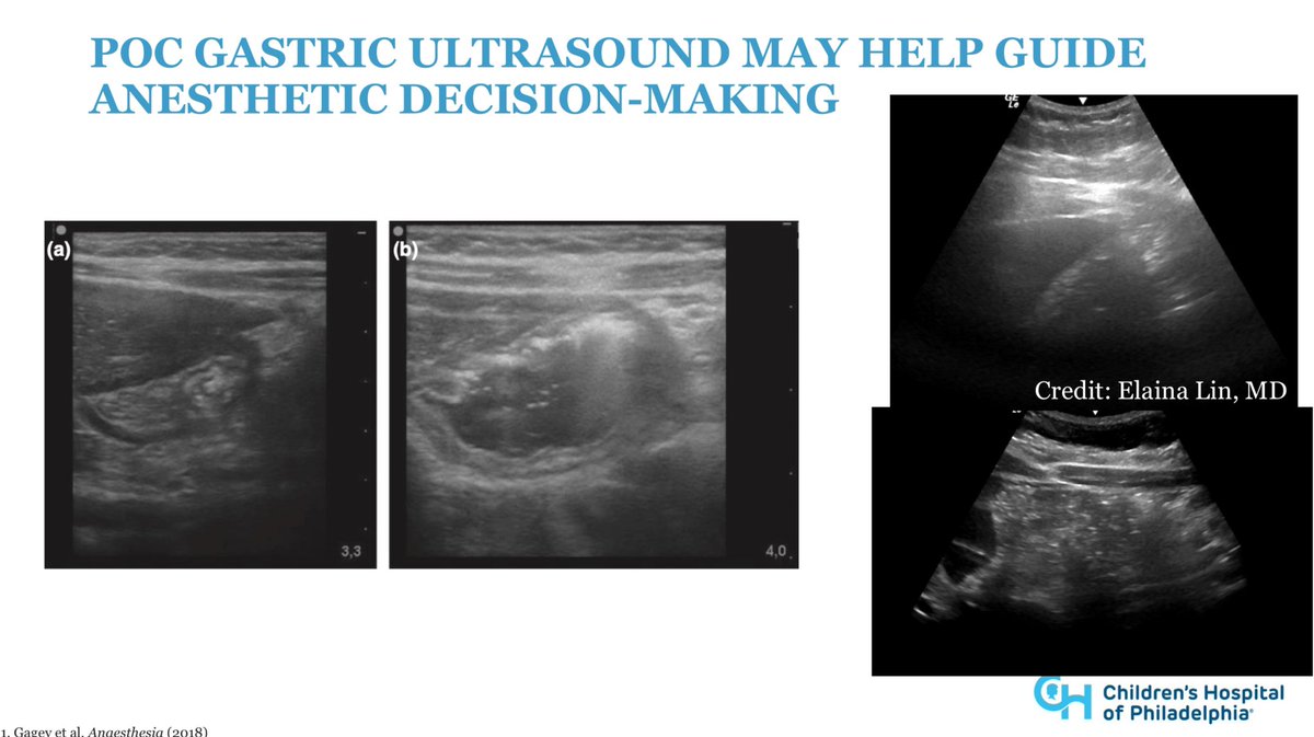 GLP-1 agonists are becoming more prevalent in adolescent patients but come with the risk of delayed gastric emptying. @ASALifeline recommendations and the use #POCUS in decision making @JessicaBergerMD @PediAnesthesia @AmerAcadPeds #PedsAnes24 #PedsAnes