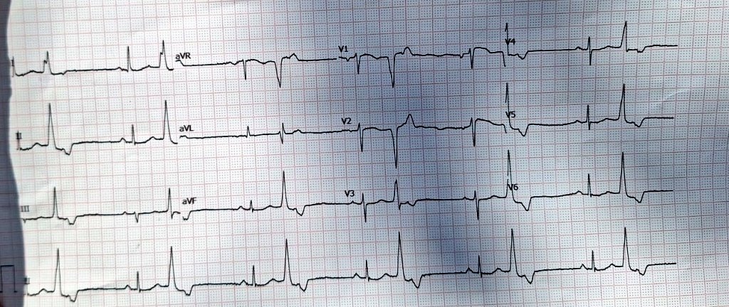 #Epeeps SOO?

#Cardiology #CardioTwitter #CardioEd #cardiovascular #cardiologist #ECG #EKG #MedTwitter #medicalstudent #MedicalEmergency #paramedics #EPS #PVCs