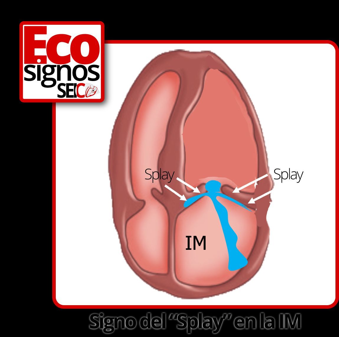 Signo del 'Splay' de la IM 📌 buff.ly/3TYnsi1 ◀️ Nuevo Eco signo creado por MA García Fernández @maecocardio