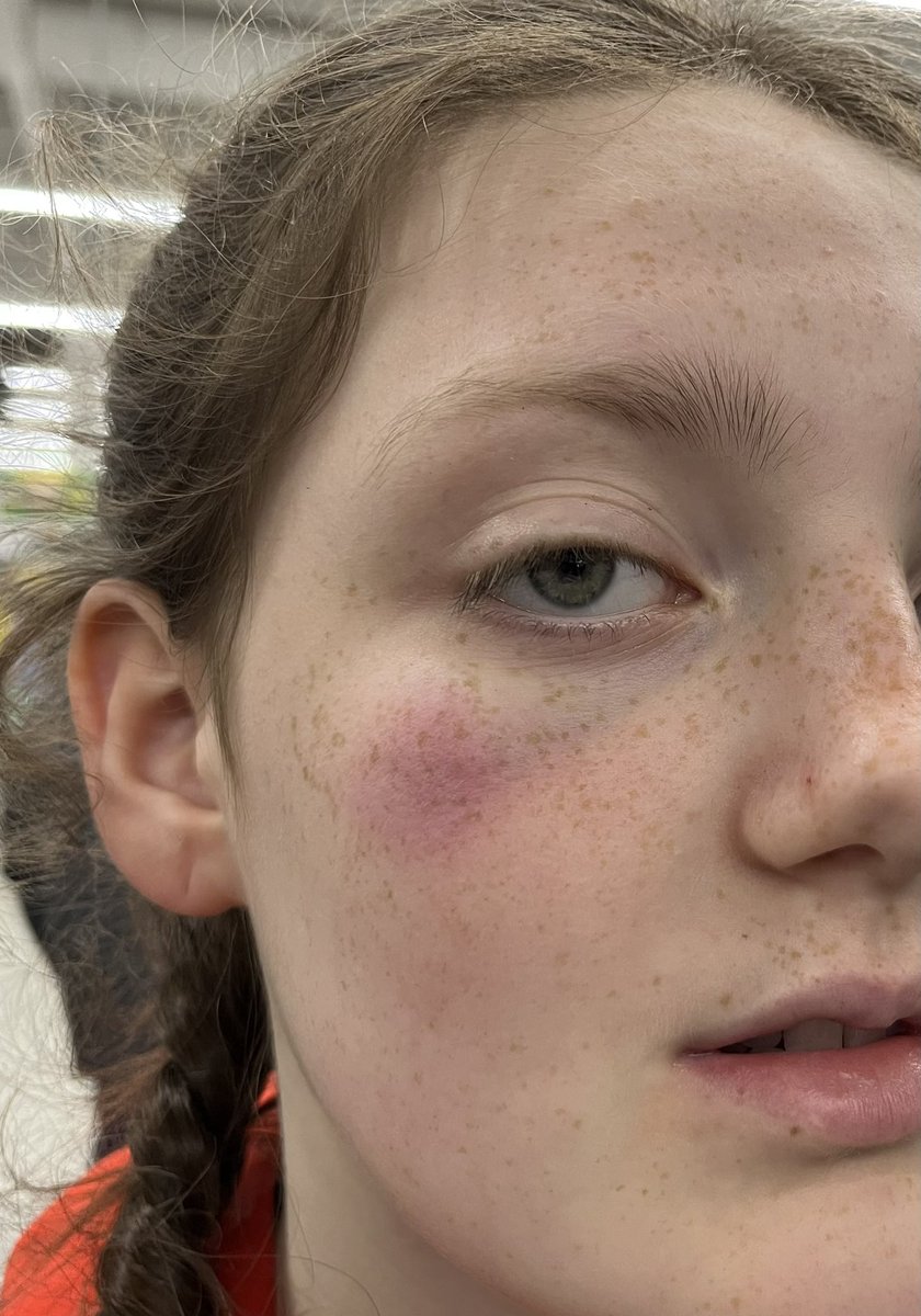 danni_masterson's tweet photo. @missyjlr23 Thank you!! She’s hoping this is as much as her eye bruises 🫣 xx https://t.co/OdjuW67uU2