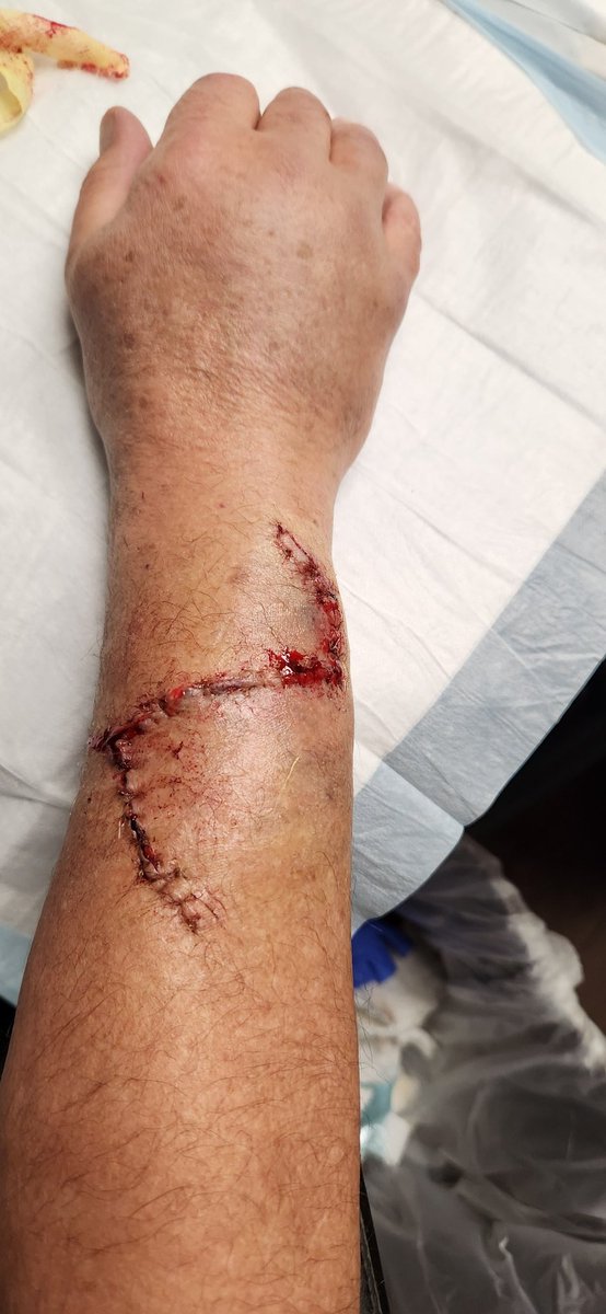 ki5qyy's tweet photo. Sliced my forearm accidentally at work... took out 6 tendons . Had to have emergency surgery because I couldn't move my fingers.  Able to move them all now. Have weeks of therapy!

The cut across sideways is mine.  The up and down cuts are from the doctors..

Nickname: Zoro-Borg https://t.co/DDVNI1Iwxe