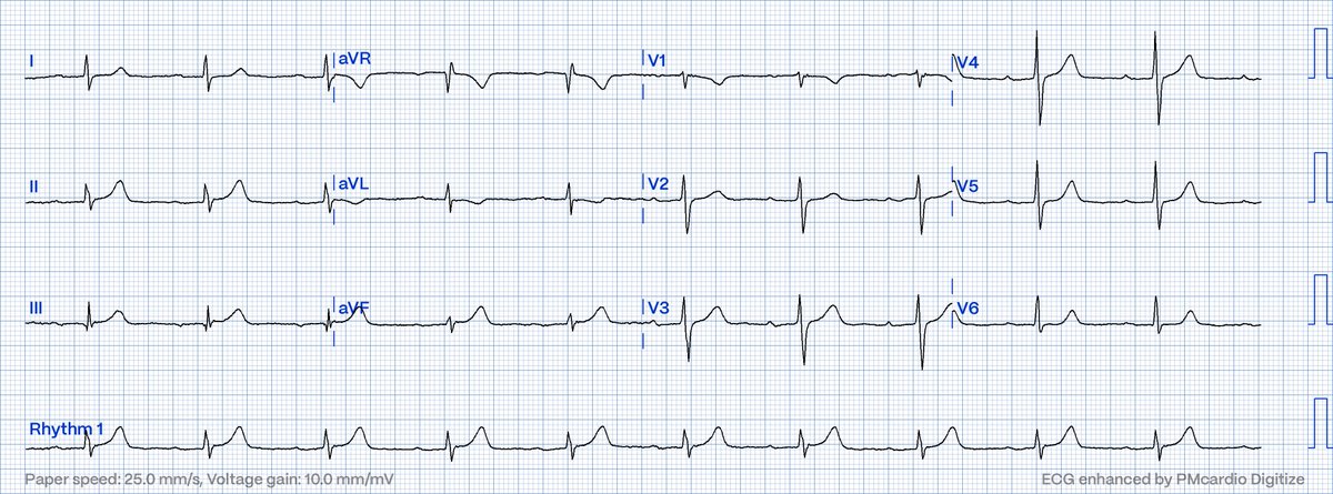 76M w/ chest pain presents with this #ECG. Can there be acute coronary occlusion?