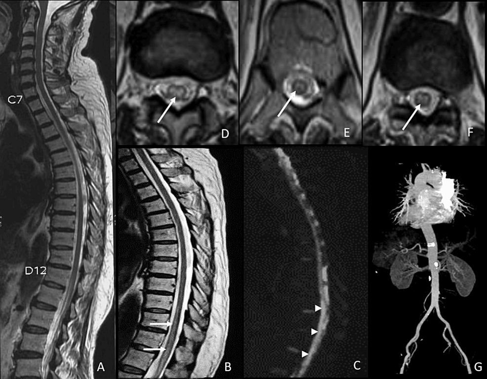 AshuPJadhav's tweet photo. Spinal Cord Infarction Thrombolysed at Seven Hours: A Case Report and Review of Literature https://t.co/7jww5lTR0v https://t.co/yhrKr3hQvU