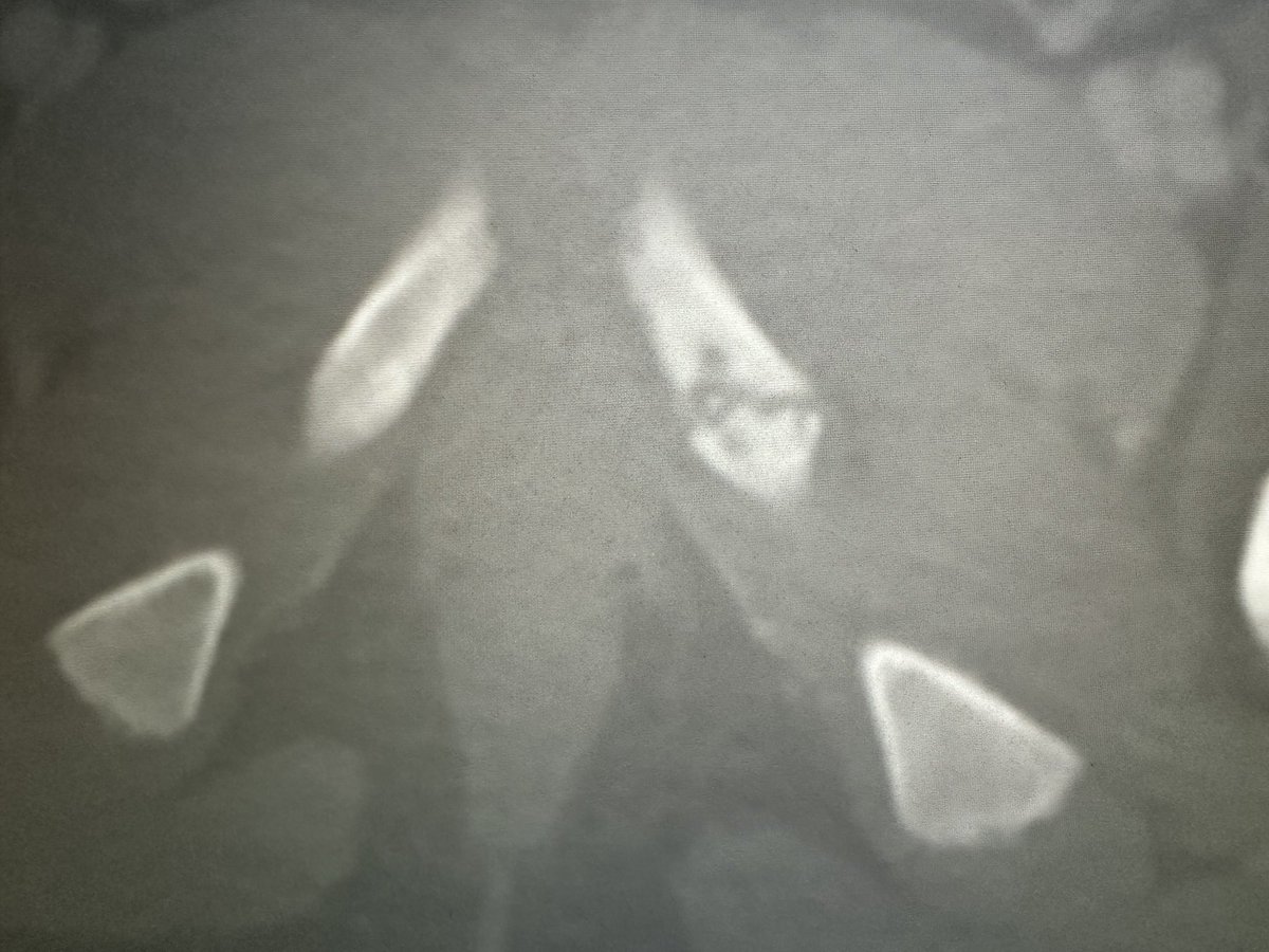 Name the most overcalled asymmetric growthplate/pseudo lesion....