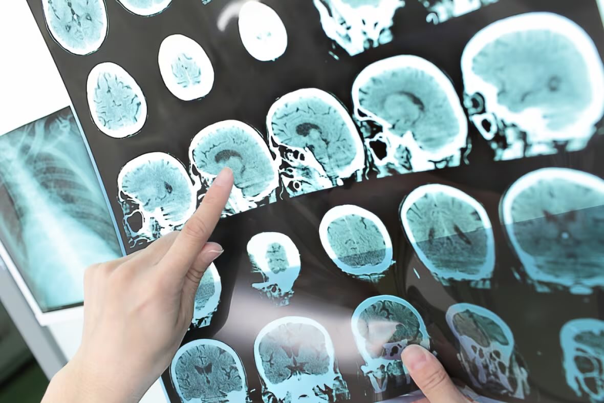 Studien zufolge verursachen #SARSCoV2-Infektionen einen Rückgang des IQ und eine jahrelange Alterung des Gehirns. Die Forscher versuchen, die tiefgreifenden Auswirkungen von #COVID19 auf das Gehirn zu erklären. „Eine der wichtigsten Erscheinungen, die Menschen nach … #Corona
