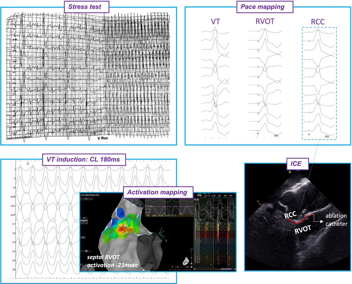 50yofemale with presyncope during exercise.  Stress testing induced PVCs and WCT
Normal ECG, echo, MRI.
CA: sevLAD stenosis - PCI performed
EPS/CA: VT induced by  isoprenaline.
SOO ablated from both RVOT  and RCC.
More workup? with <a href="/SteliosTzeis/">Stelios Tzeis</a> and <a href="/V_Michopoulos/">Vassilis Michopoulos</a> #Epeeps