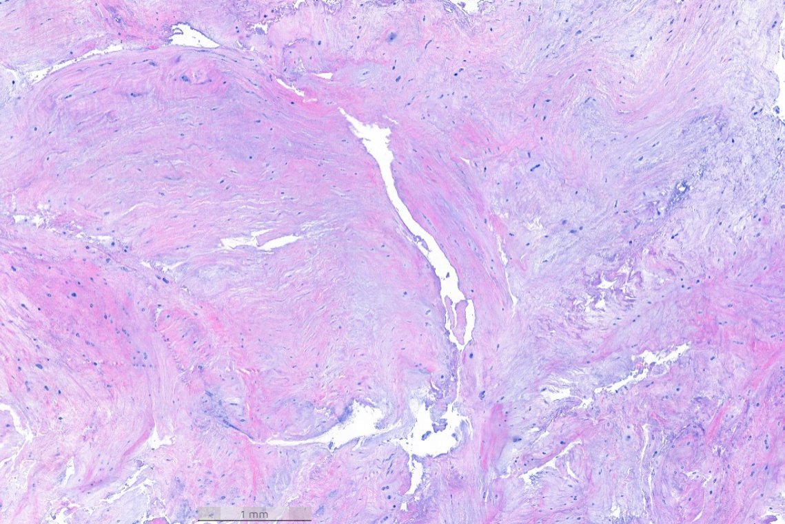 #EverydayBST
Spinal tumor?
See answer👇
Dr. Nielsen #USCAP2024 #BSTPath #pathology #PathX #PathTwitter