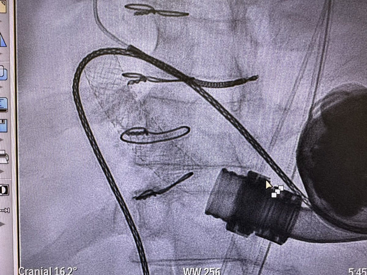 ut2087's tweet photo. @pras_senMD @AQaviMD @QasimRazaMD Nice! Picture from our case. Important to have the stent as far into the outflow graft as possible. Luckily the gap didn’t prove to be an issue as the gradient resolved completely. https://t.co/EuhYqTcvKV