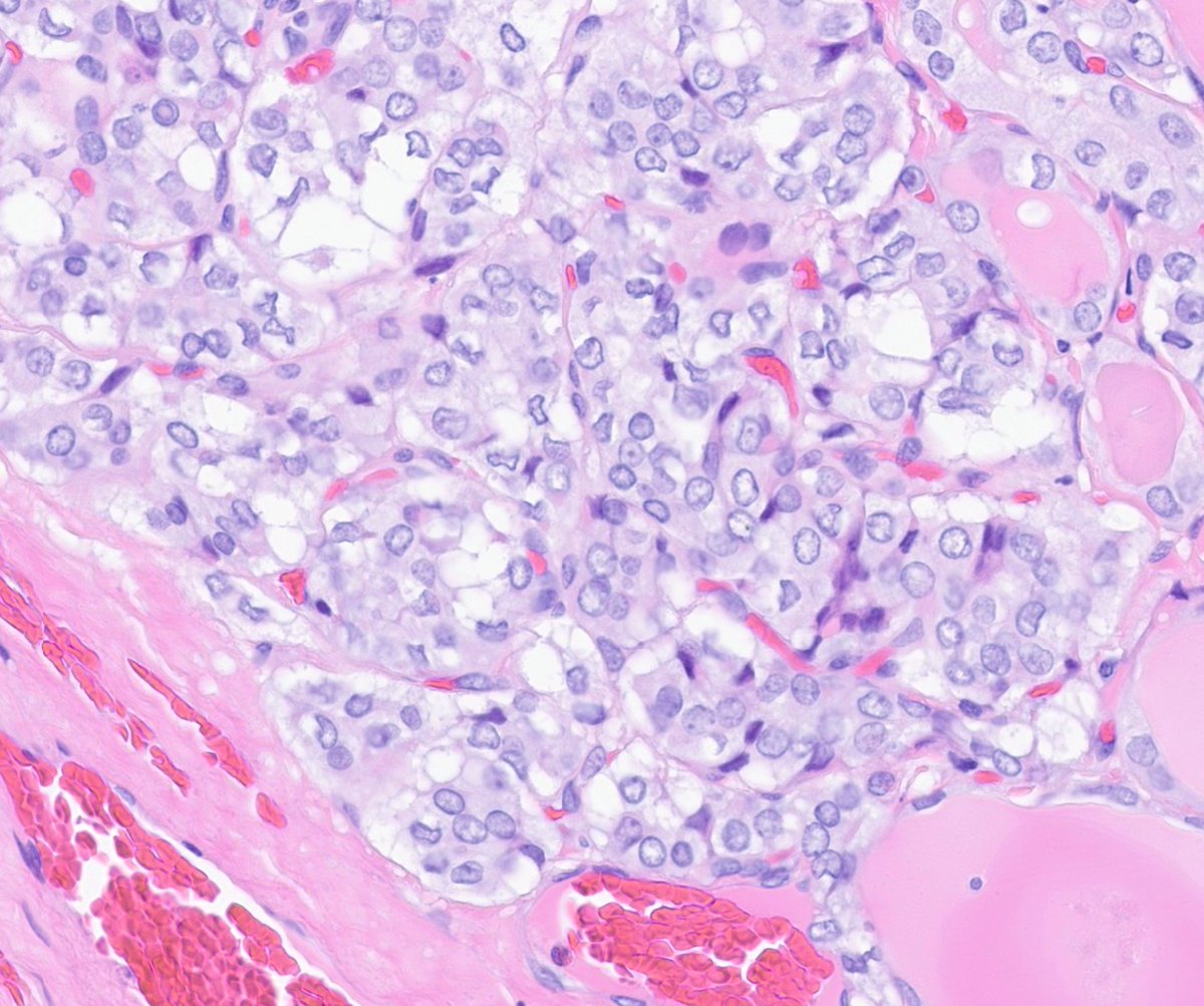Nice example of thyroid NIFTP from my #endocrine #pathology consultation practice @UMichPath Circumscribed mass, pure follicular pattern, PTC-like nuclei, no invasion, and no papillae. Saves the patient a full cancer diagnosis.