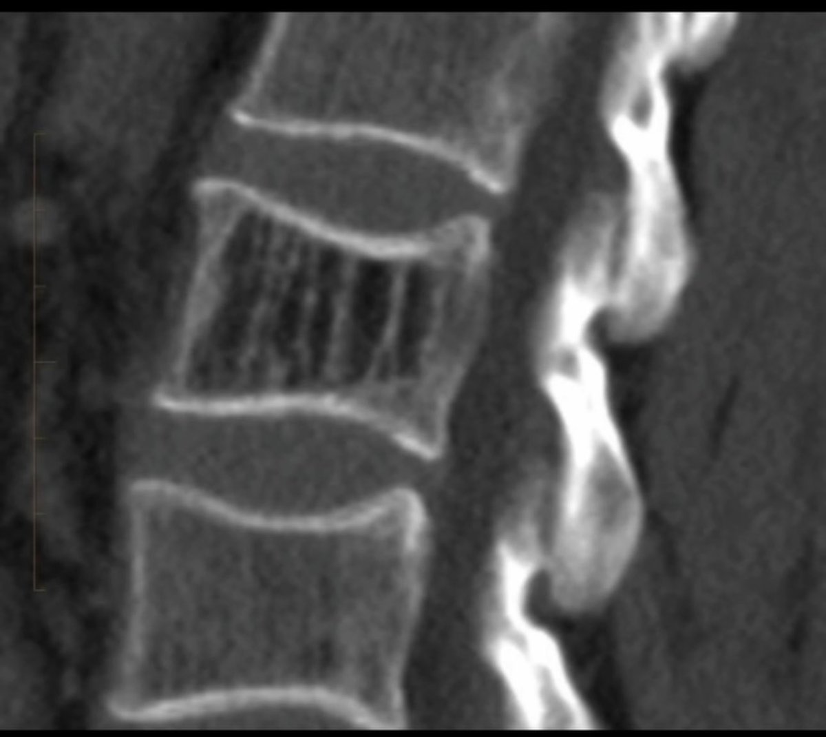 OGdukeneurosurg's tweet photo. What is this jail bar appearance ? https://t.co/IjYE5XlTYi