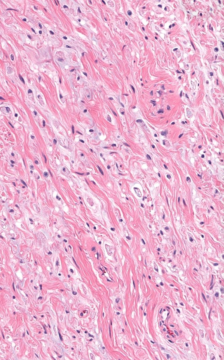 Deep soft tissue mass.
WSI digital slide: kikoxp.com/posts/24672 
Gross pathology images: kikoxp.com/posts/24674
Answer & video: kikoxp.com/posts/15037 
#pathology #pathologists #pathTwitter #dermpath #dermatology #dermatologia #dermtwitter #BSTpath