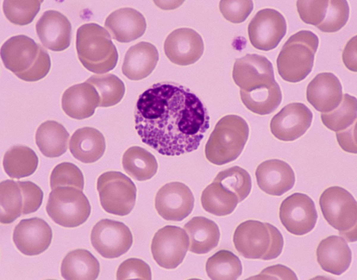 Amazing VMR discussing the mighty Eosinophil 💪🏽
Quick differential for Eosinophil &gt;5K ⬆️⬆️⬆️ (and ~= neutrophils &gt;100K, admit these pts‼️) 
1. Atopic- Allergic bronchopulmonary aspergillosis 
2. Infections 
3. Autoimmune- eosinophilia GPA (up to 50% with ➖ANCA) 
4. Cancer