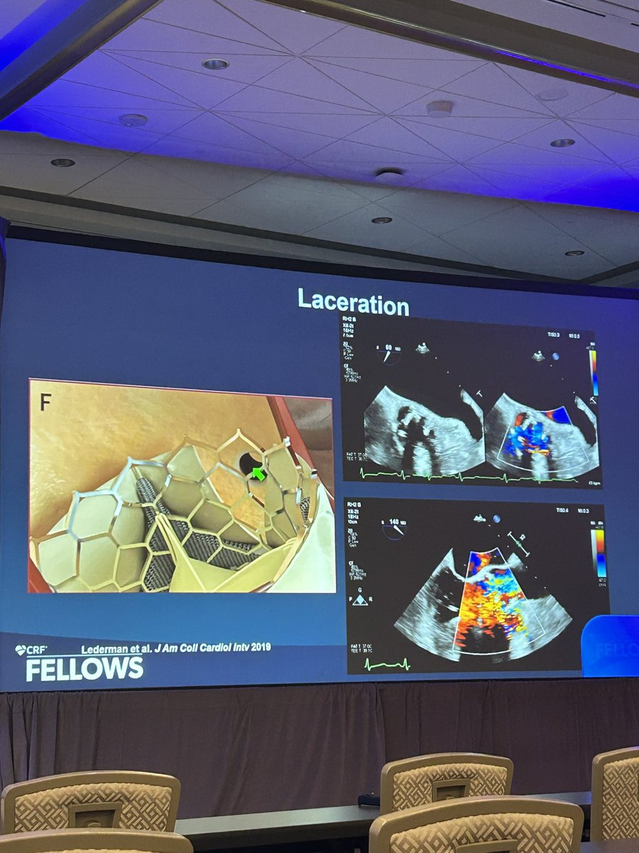 Such a broad landscape of topics covered in a matter of a few hours @crfheart #fellows2024:
📍Bifurcation lesions and strategies on how to treat
📍CTO wiring methods
📍ISR mechanisms and how to approach
📍Coronary protection through leaflet laceration for TAVR
#CardioEd