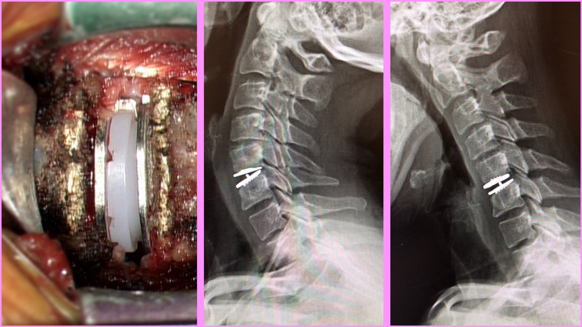 Total disc replacement can be a great non-fusion option in the right patient candidate. #neurosurgery