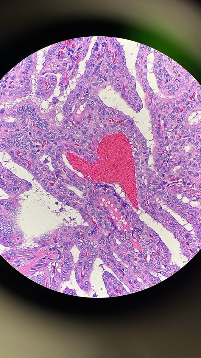 You may find love in the strangest places … like in a papillary thyroid carcinoma. Where the Annies are orphans.