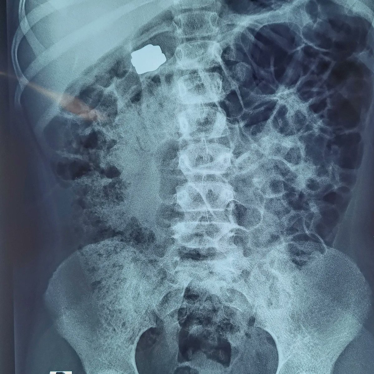 IvonneMerlos's tweet photo. CUIDADO! ☢️
La ingestión de múltiples imanes representa mayor riesgo, la presión ejercida podría provocar: erosiones, úlceras, isquemia y necrosis de la pared, perforación, obstrucción intestinal y fístulas. 
Importante:  extracción oportuna! 
#endoscopia #gastropediatria https://t.co/Ur2OV9o0gn