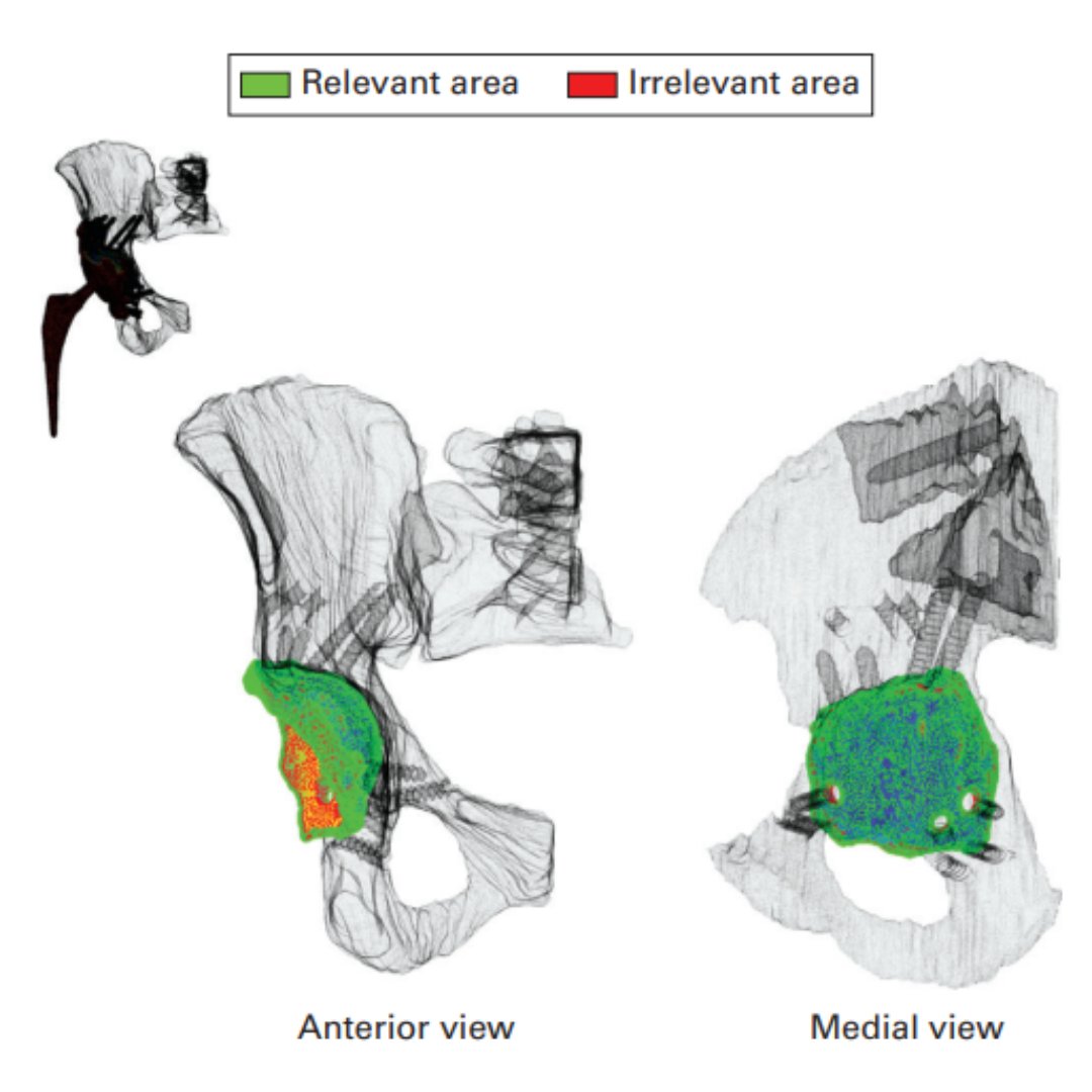 There was a statistically significant increase of scaffold-bone contact area over time, but the total contact area of the scaffold in relation to the acetabular bone remained relatively low.

#CTScan #BJJ #Radiology

ow.ly/R4MW50R7sL7