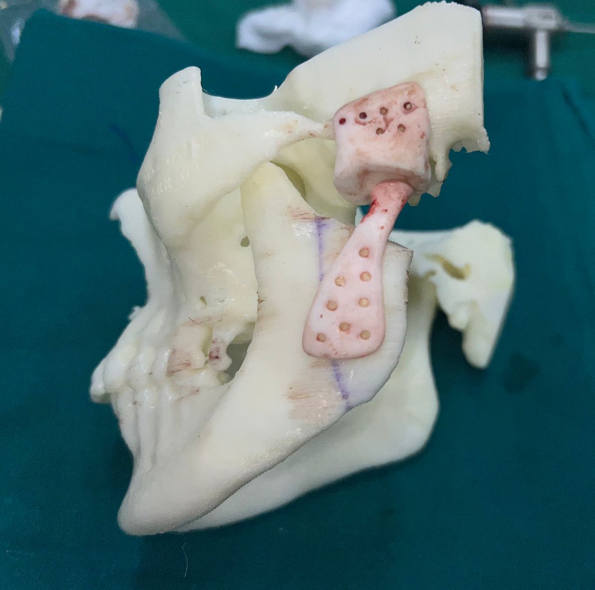 Here's the 3D model of Saba Shaikh's skull. After chemo, she developed locked jaw, surviving on a liquid diet for a year, weighing only 40kgs. Using MRI and CT scans, doctors used this cutting-edge tech to understand her skull's anatomy for her surgery. indianexpress.com/article/cities…