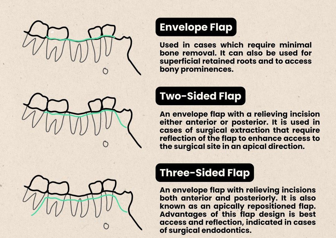 💡| Types of Flaps #Aboutdent