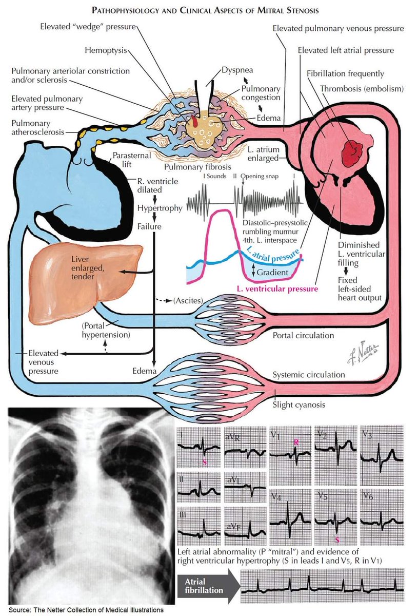 Pathophysiology and Clinical Aspects of Mitral Stenosis Subscribe 👇 youtube.com/@pgmedicine2023