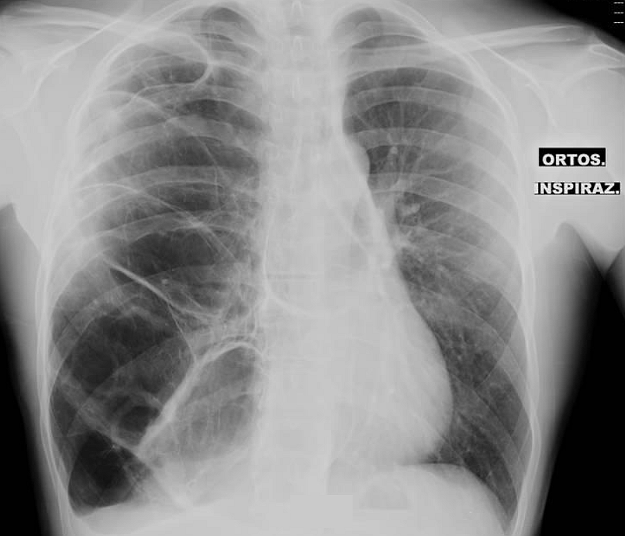 A 21 y/o male patient was admitted to the Emergency Department for right subscapular pain and tachycardia suspicious for pneumothorax. - What's the diagnosis ? ➡️ Answer and Full Case: manualofmedicine.com/spot-diagnosis… #medtwitter #foamed #foamrad