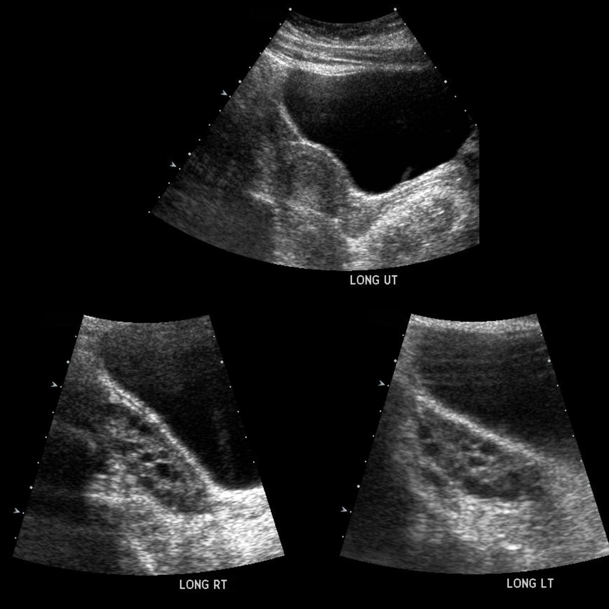 Teen with irregular menses

Sagittal US of pelvis shows normal uteru(above)+enlarged ovaries bilaterally(below), with each ovary containing a larger number of follicles (>20) than normal

#FOAMed #MedEd #FOAMPed #FOAMRad #PedsRad #RadEd #RadRes #radiology #PedUro #FOAMus #USRad