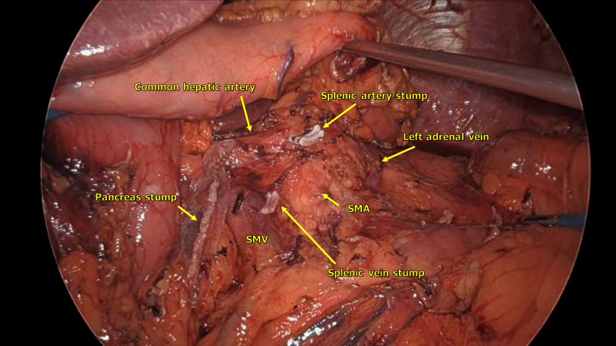 Anterior RAMPS for pancreas body neoplasm. 77 years old. POS 2 days.
After knowing the results of the PANDORINA study, we agree with not to use more abdominal prophylactic  drainage after left pancreatectomy. In Spain, Dr. Pardo and Dr. Rotellar have been saying it for years.