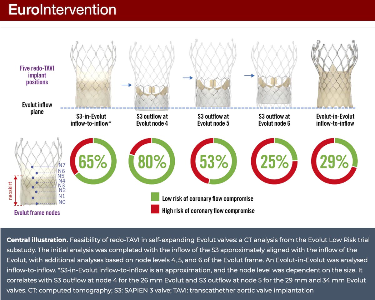 This CT-based simulation study suggested a high implant position of the index Evolut in the presence of a small aortic root anatomy may compromise coronary flow and lead to challenging coronary access after redo-TAVI. Read more. #EIJBestOf eurointervention.pcronline.com/article/feasib…