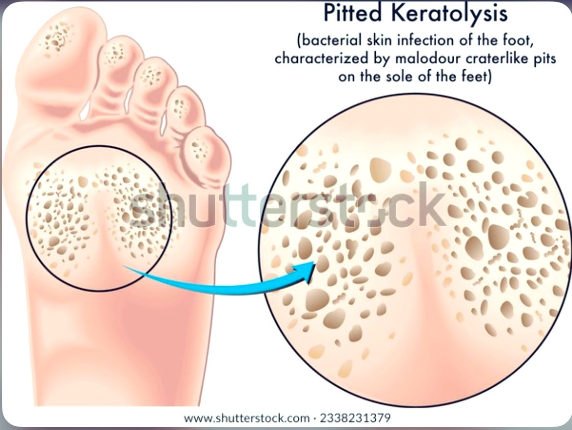 @Gazelle6849 @fxgodzeuss @IhabFathiSulima Keratolysis plantare sulcatum (Pitted keratolysis ) is a bacterial infection of the arch of the foot.
 
📍Occurs with poor foot hygiene.
 
📍Can be treated with adequate foot hygiene, topical antibiotics, & antiseptics.