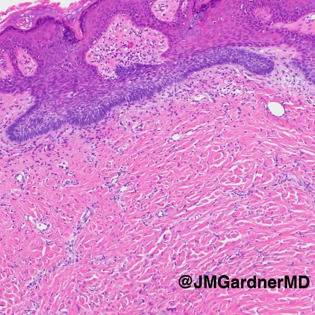 A Classic! Diagnosis? 
Answer ✅ kikoxp.com/posts/17988 
Videos ⏯️ kikoxp.com/posts/7974 & kikoxp.com/posts/3895
A similar case (with a twist!)🔬kikoxp.com/posts/3745 
#BSTpath #pathology #pathologists #pathTwitter #dermpath #dermatology #dermatologia #dermtwitter