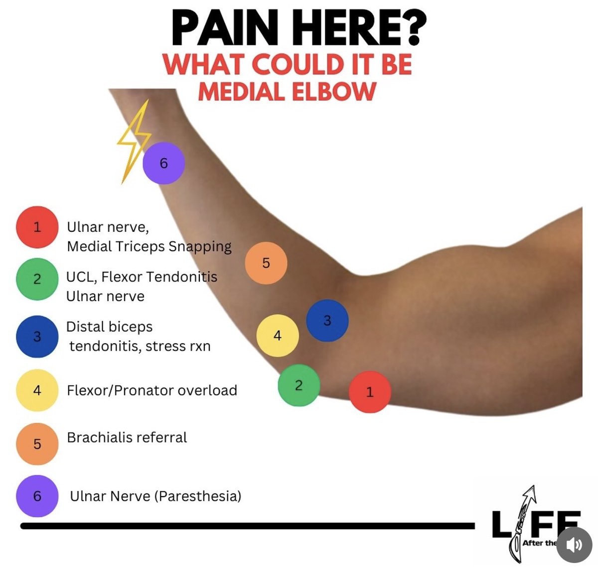 OGdukeneurosurg's tweet photo. What causes elbow pain? https://t.co/Zg1Osi7Agg