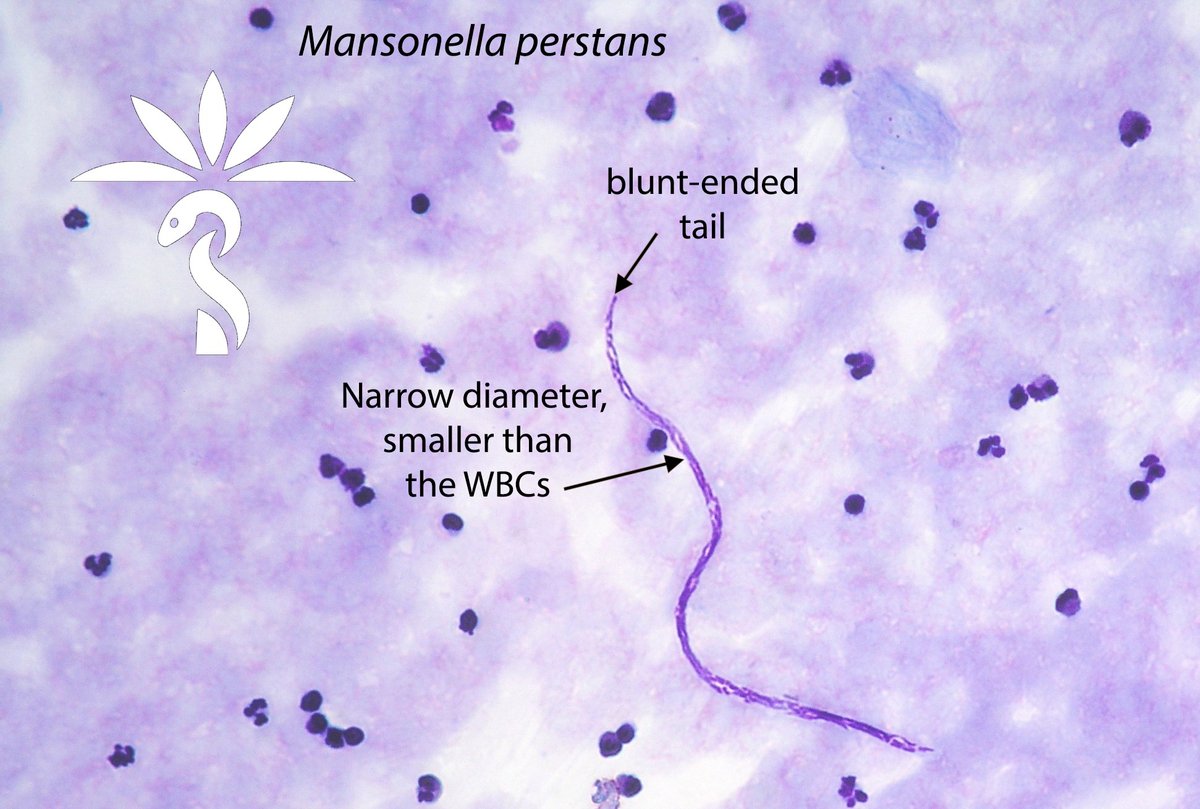 The answer to the #Parasite Case 744 is now up: Mansonella perstans. See further discussion here for the key ID features: parasitewonders.blogspot.com/2024/04/answer…. Up next – the skin microfilariae! Thank you Idzi Potters and @ ITMantwerp. #mayopath #pathology #CrittersOnTwitter #PathBugs