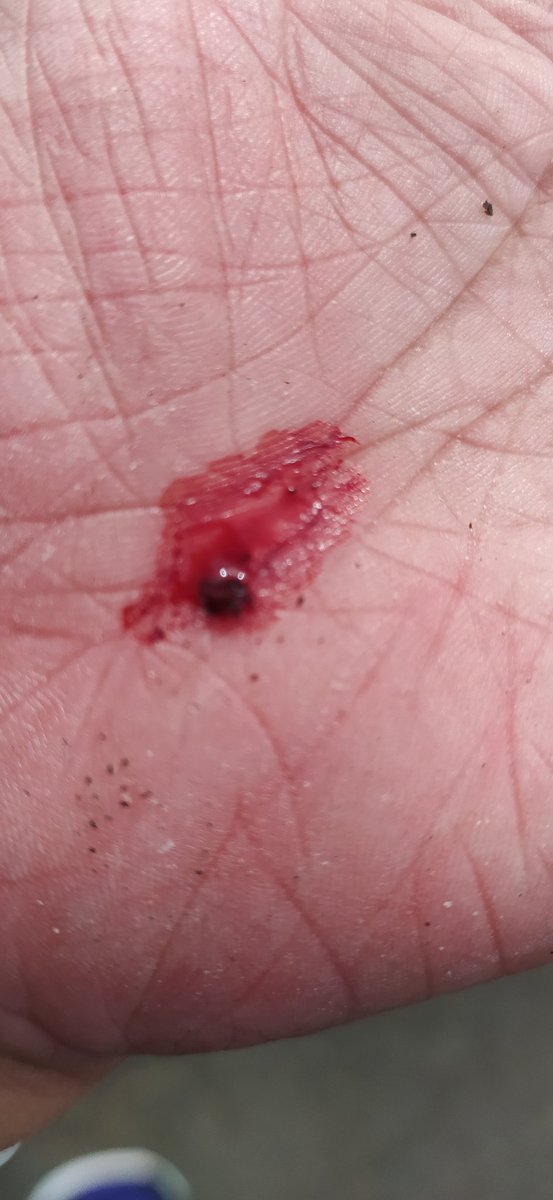 SuhanaAh's tweet photo. Think my running journey is over...
Didn't make it2 10k as ran past a man who whistled at me &amp; then stuck his foot out.
Couldn't dodge it fast enough so went flying.
Not sure I'll have the confidence to go out again 
Being a woman feels really hard sometimes... 😔😔 #running https://t.co/5qpW0POByx