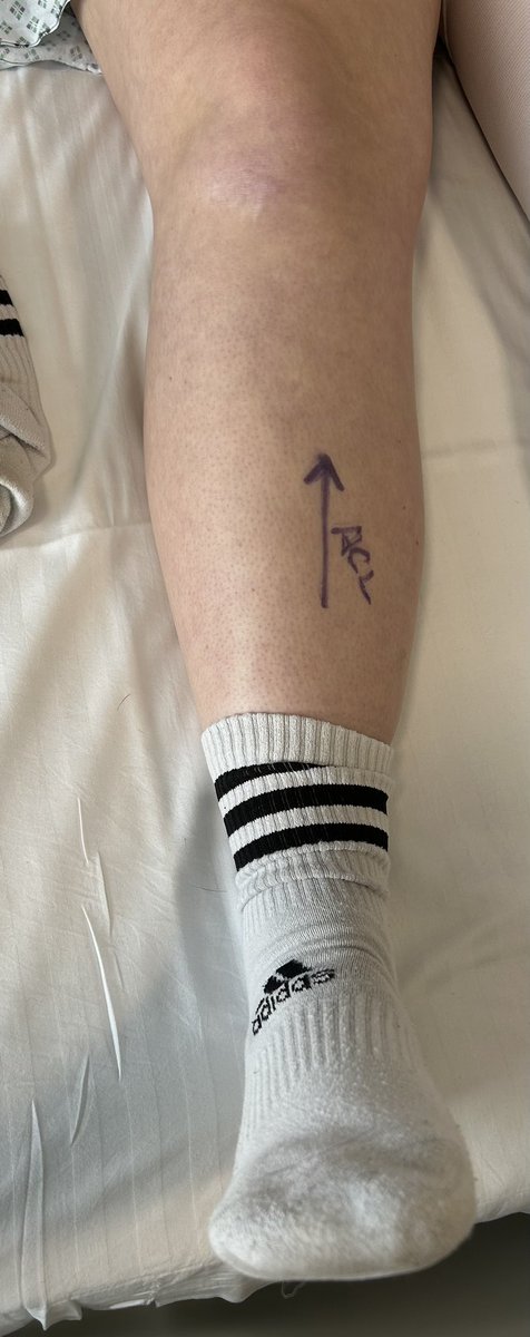 thomid76's tweet photo. Amber's ACL reconstruction surgery complete ✅
Road to recovery starts now 🧤🧤 https://t.co/MopqJybyQx