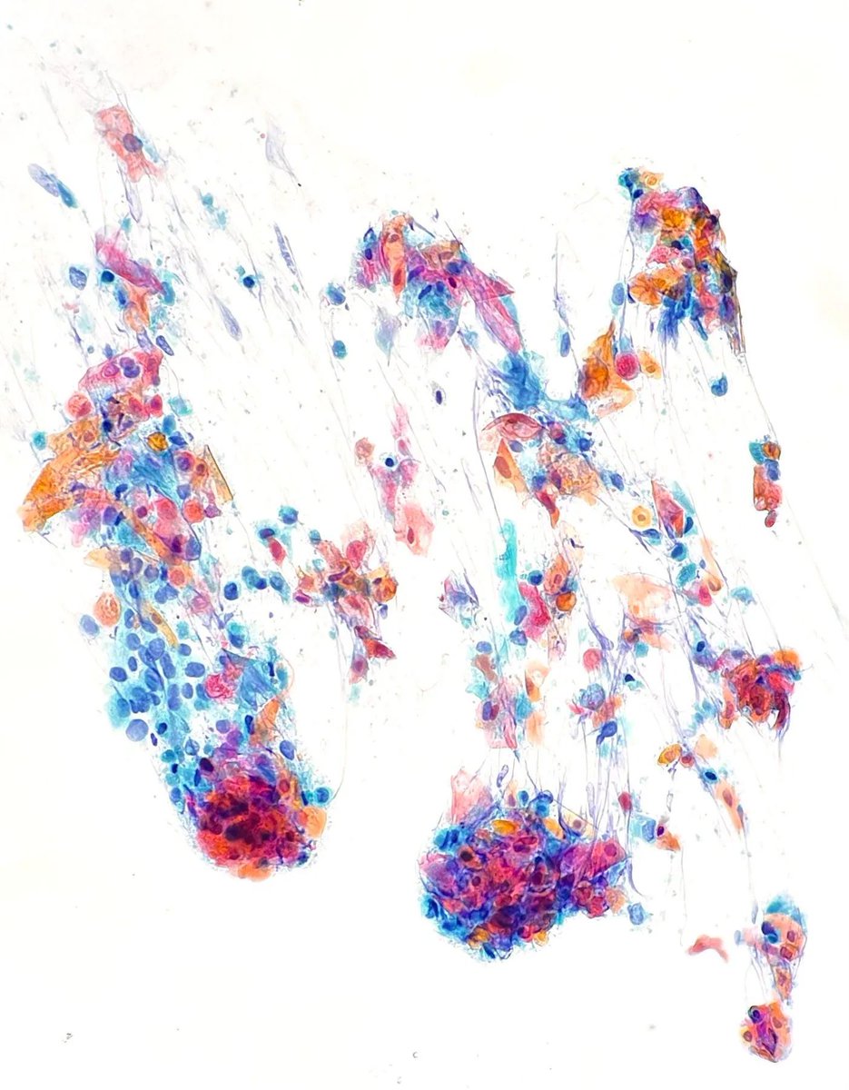 Fine needle aspiration of a lung mass revealing what type of tumor cells? Answer: buff.ly/494ZoAE #CytoPath #PathArt #PathTwitter #MedTwitter