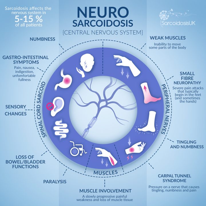 Sarcoidosis can occur in almost any organ. In 5 to 15% of patients with #sarcoidosis, the disease occurs somewhere in the nervous system. This is called #neurosarcoidosis. ~🦋 #SarcoidosisAwarenessMonth #SarcLife #SarcStrong #SaySarcoidosis