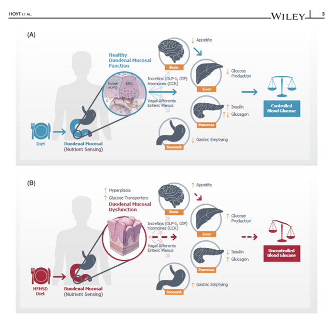 Duodenal mucosal resurfacing can improve metabolic parameters, including fasting plasma glucose, A1c, liver fat, liver transaminases, insulin sensitivity, and body weight. …ubs.pericles-prod.literatumonline.com/doi/10.1111/do…