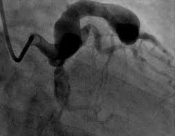 IhabFathiSulima's tweet image. A 47 years old male who is Hypertensive and heavy Smoker presented with acute anterior STEMI after thrombolysis he was taken to the catheterization lab.
What are the findings?
#coronary
#Cardiology #CardioTwitter #CardioEd #MedTwitter #MedEd #MedX