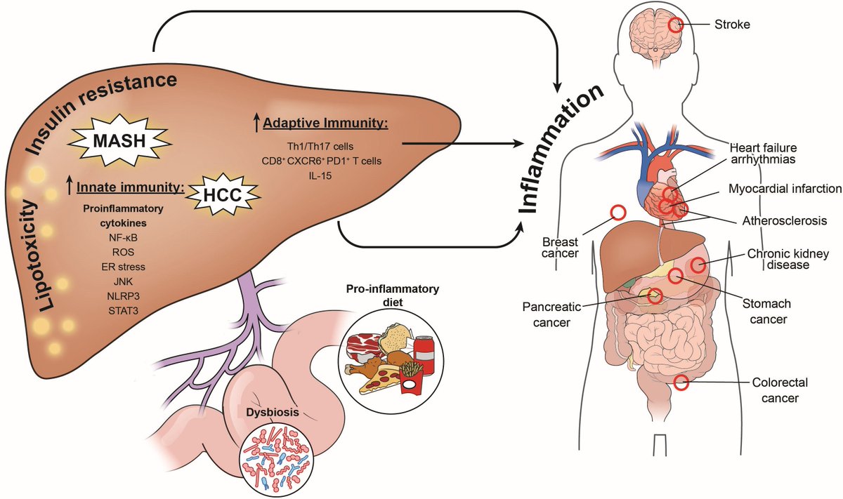 #GUTImage from the #RecentAdvancesInClinicalPractice paper by Targher et al entitled
  
'MASLD: a systemic metabolic disorder with cardiovascular and malignant complications' via bit.ly/43onbJB

#MASLD