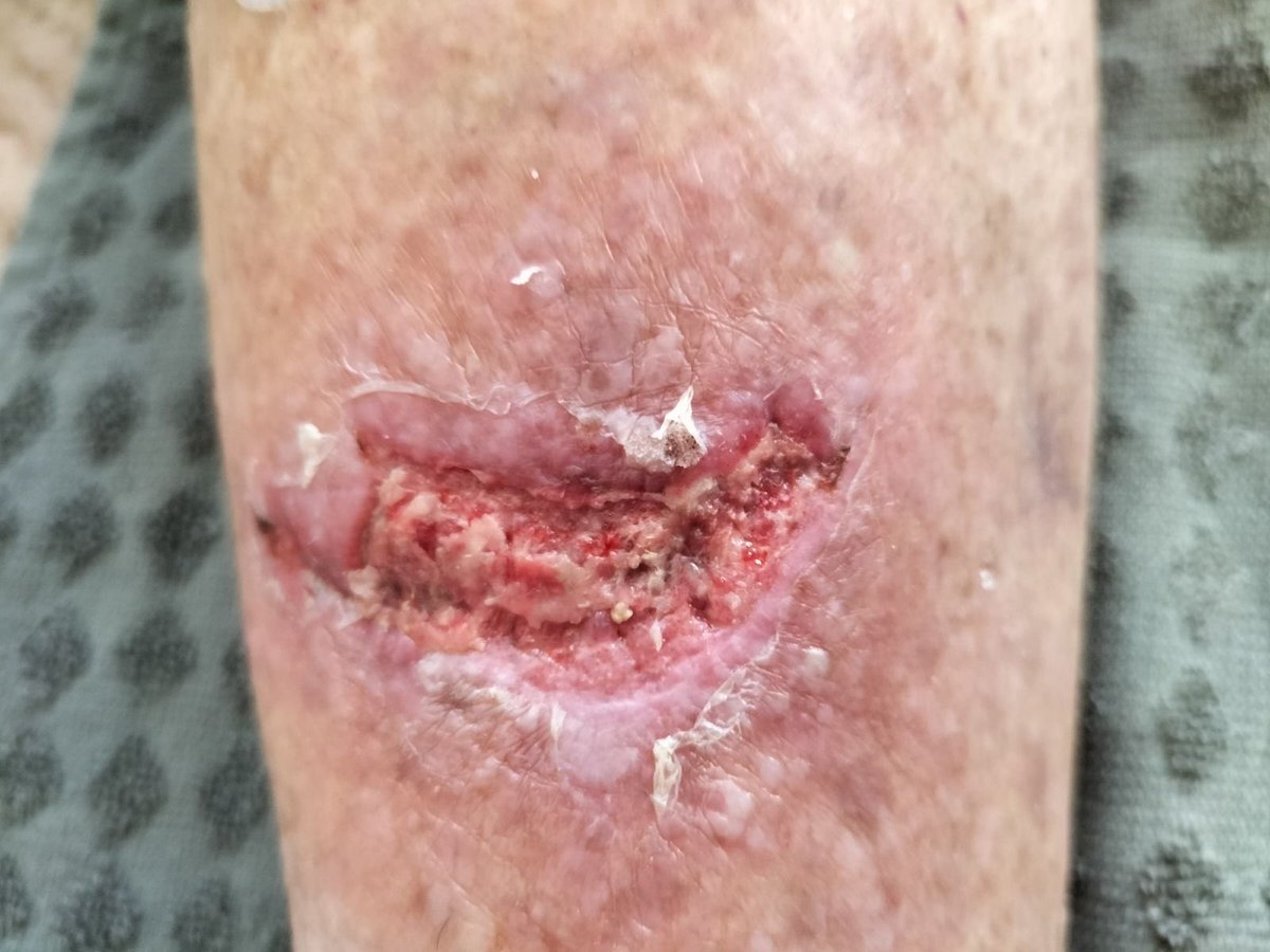 Zazapicouze's tweet photo. Je lance un petit pavé histoire de bien faire comprendre l’expertise infirmière en terme de prise en charge de plaies : 
- patiente sort du SAU avec sutures, elle fera ses psts en autonomie (lol)
- va voir son MT pour ablations des fils
- résultat à J15 
#reconnaissanceinfirmiere https://t.co/liuPU1ZUae