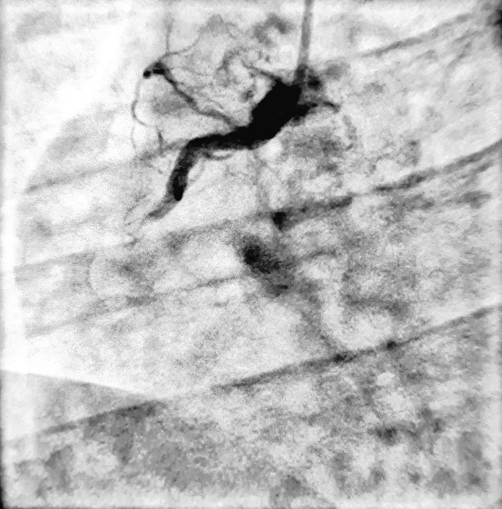 HatimLawati's tweet image. Aspiration #thrombectomy in #STEMI can sometimes retrieve more than just the #Thrombus !! [clot + lipid debris] 

#Fellows2024 #EAPCI #Cardiology #CardioTwitter #ACCFIT 

@mirvatalasnag @AdilRiyami @AlkashkariWail @SACIS_KSA @APSIC6 @PCRonline @FBardooli @SCAI @crfheart